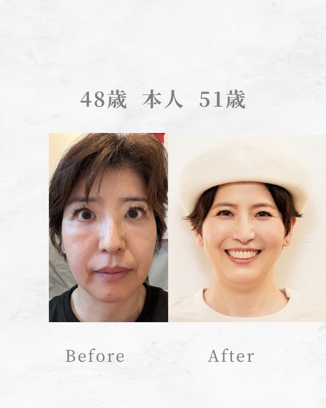 細胞レベルの肌アイロンコース 経過写真 — 48歳 → 51歳