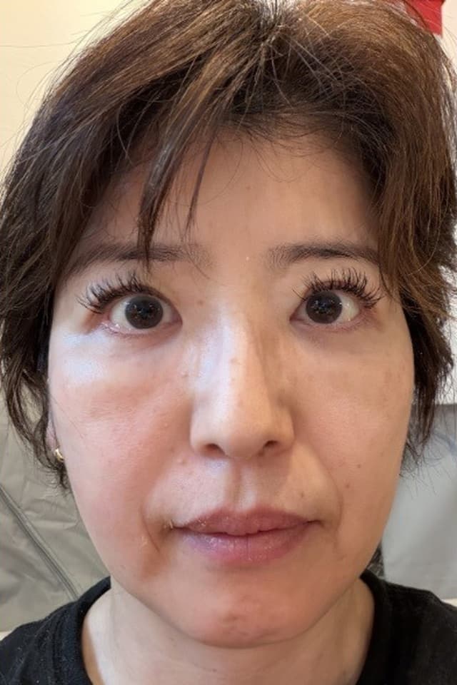 細胞レベルの肌アイロンコース 経過写真 — Before 48歳